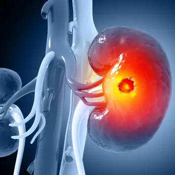 A Beginner’s Guide to Dialysis: Everything You Need to Know Before Starting Treatment