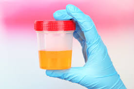 Calcium Oxalate Crystals in Urine