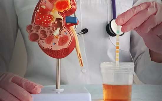Nephrotic Syndrome