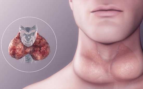 Hypothyroidism