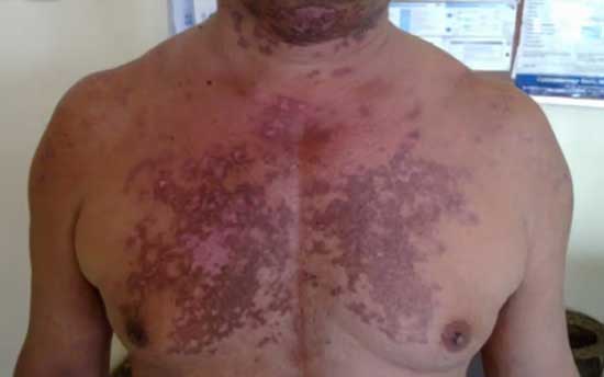 Systemic Erythomatous Lupus